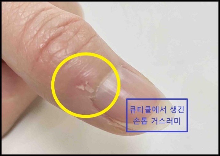 큐티클 위에 자란 조갑주위염 원인이 되는  손톱 거스러미