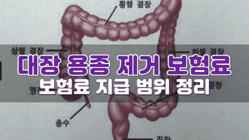 대장 내시경 용종 제거 보험료 지급 4가지 경우(ft. 대장 용종 수술 후기) - 정보백과